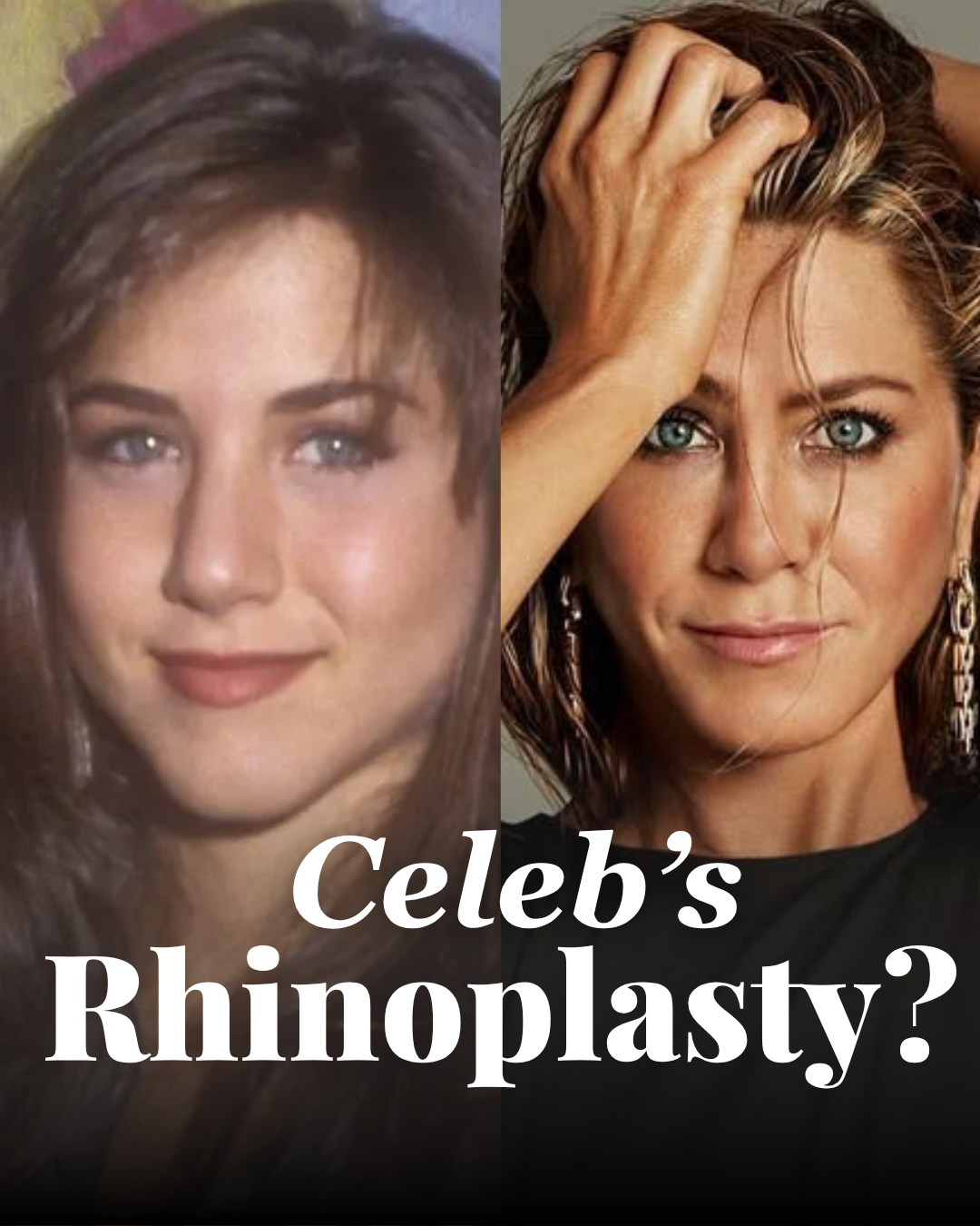 Tijuana rhinoplasty before and after example – celebrity comparison