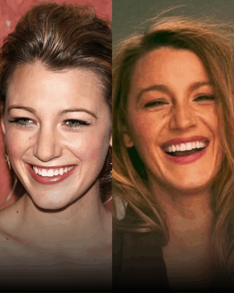 Tijuana rhinoplasty before and after example – celebrity comparison