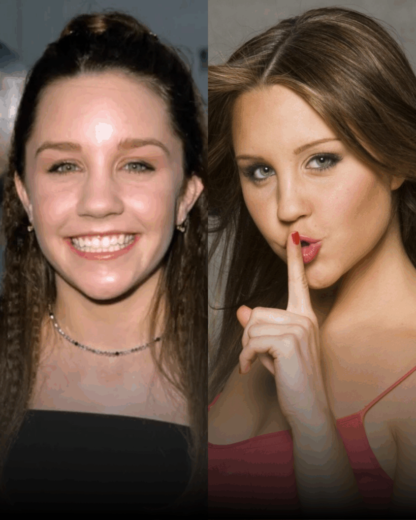 Tijuana rhinoplasty before and after example – celebrity comparison