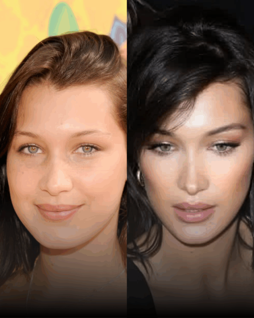 Tijuana rhinoplasty before and after example – celebrity comparison