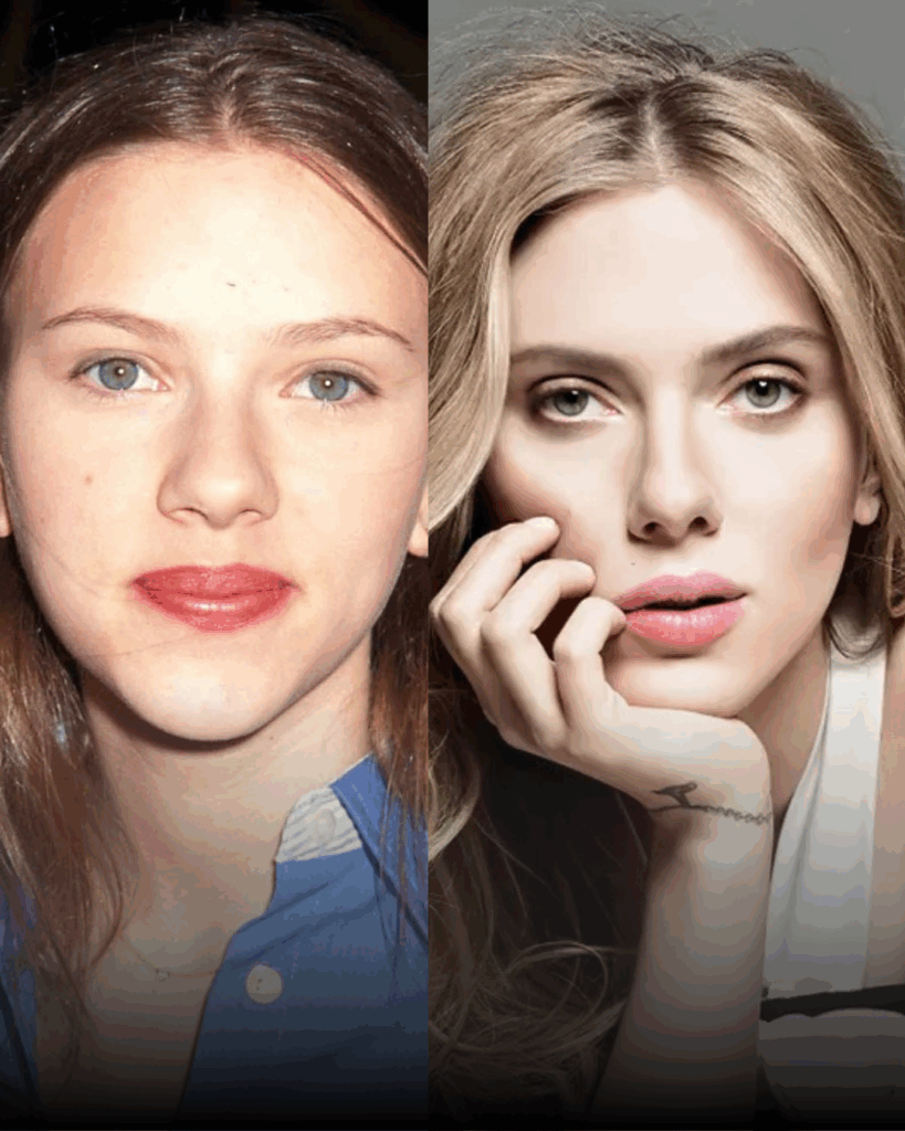 Tijuana rhinoplasty before and after example – celebrity comparison